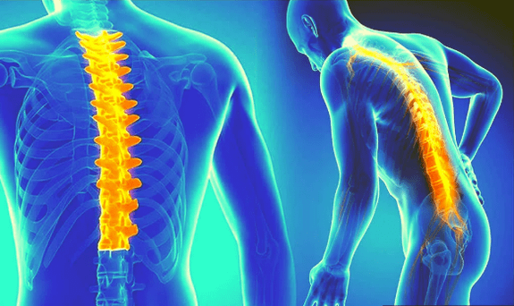 Osteochondrosis of the spine