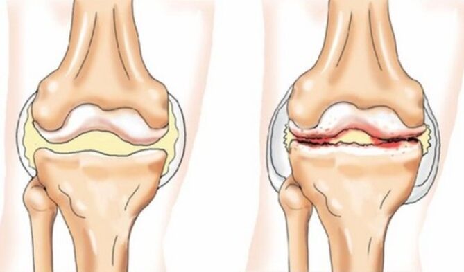 Changes in arthritis and arthritis