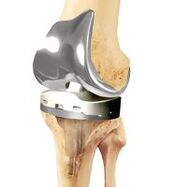 Prosthetic