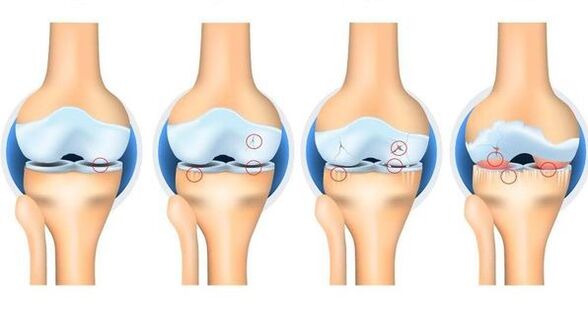 Stages of osteortrosis