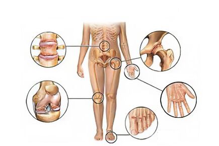 Types of arthrosis