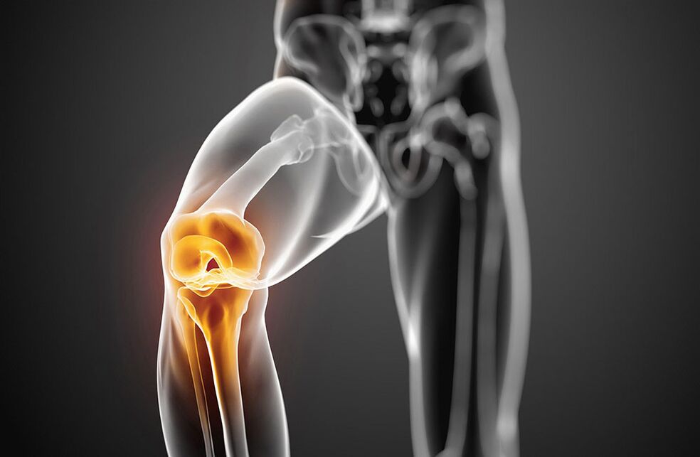 Arthritis of the knee joint