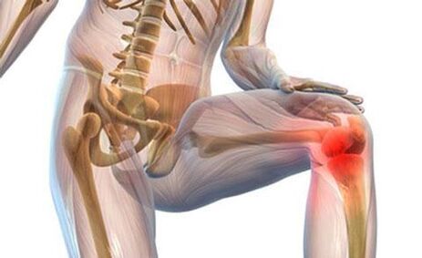 Arthritis of the knee joint