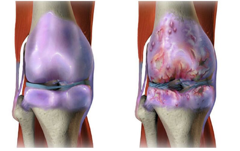 healthy cartilage and destruction of the knee joint with osteoarthritis