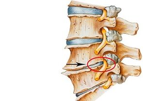 Causes of cervical osteochondrosis