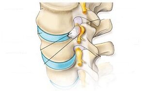 The main symptoms of cervical osteochondrosis
