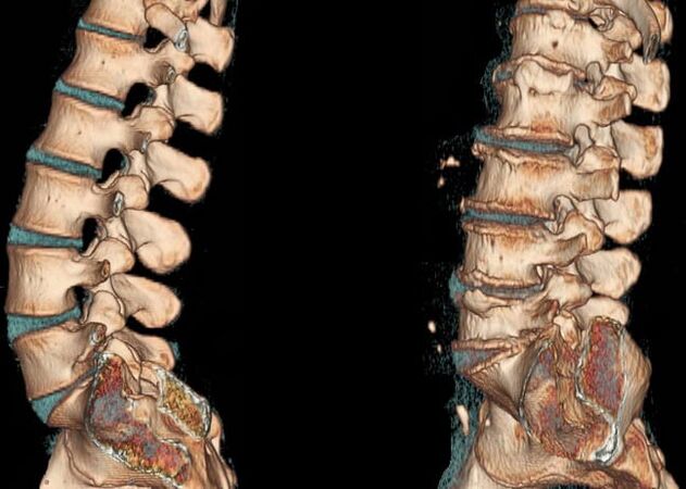 CT scan of the lumbar spine under normal conditions and with osteochondrosis