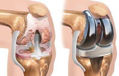 Knee joint endoprosthetics with gonarthrosis